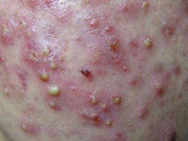 痤疮类型之结节痘囊肿痘脓包痘