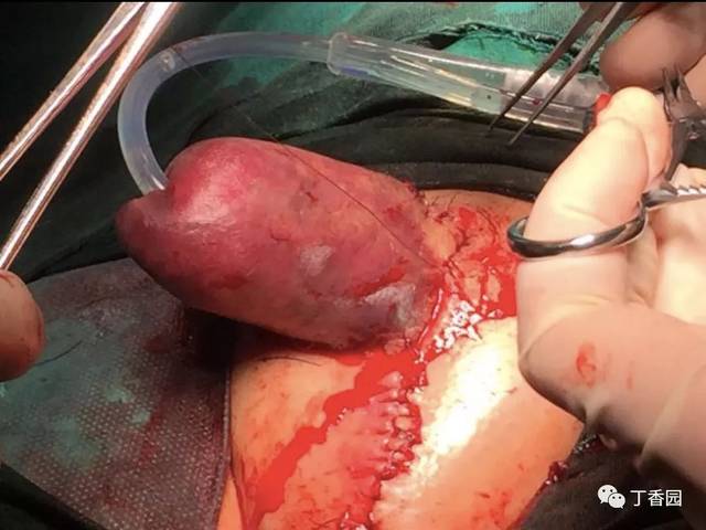 抑郁症患者切下自己的阴茎和睾丸,医生是如何缝回去的