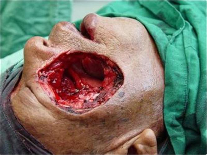 颌面部肿瘤切除图片