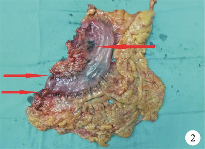纳米碳淋巴示踪剂在腹腔镜辅助下进展期胃癌根治术中的应用及评价