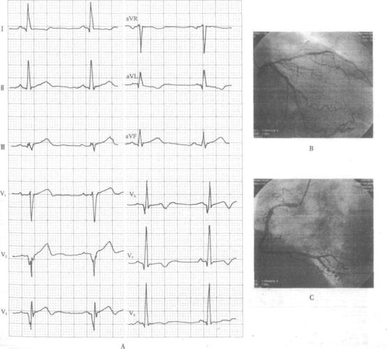 前降支近段病变致急性前壁心肌梗死-精编心电图诊断