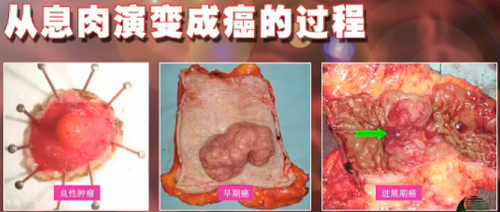 肠癌的早期症状及肠癌的治疗和预防