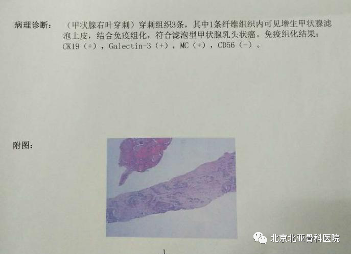 穿刺后病理结果为滤泡型甲状腺乳头状癌.