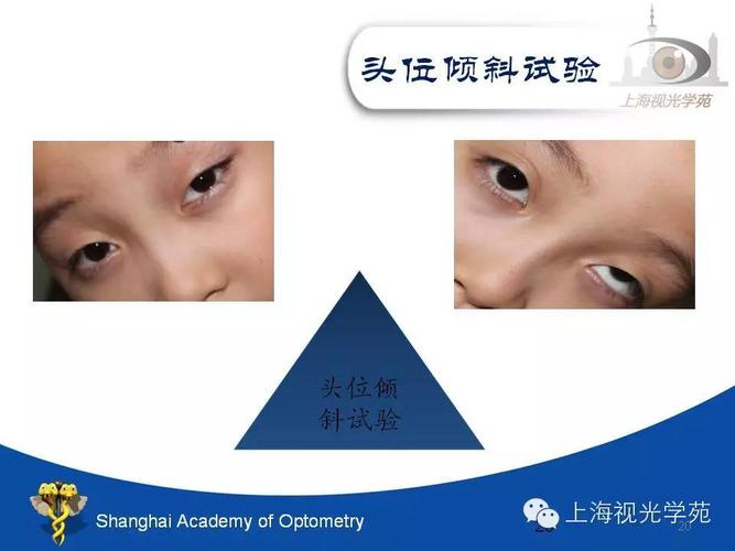 检查时,患者若有头向某肩倾斜的代偿头位时,叮嘱患者下颌稍内收,将头