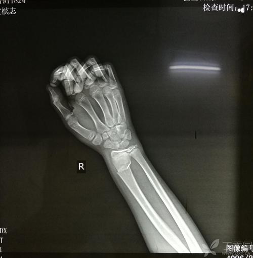 左右桡尺骨远端骨折,手法夹板固定 [病例帖]