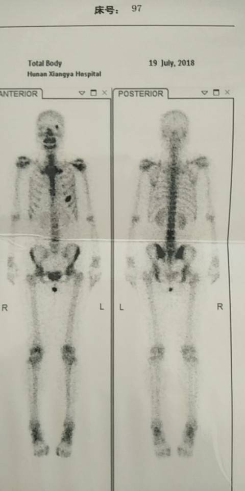 骨扫描和胸透结果