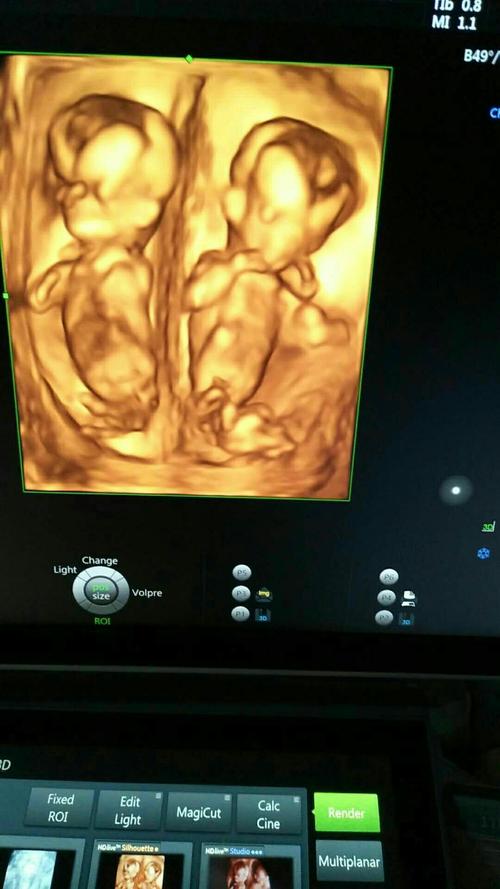 孕妈注意了不要错过四维彩超的检查最佳时间