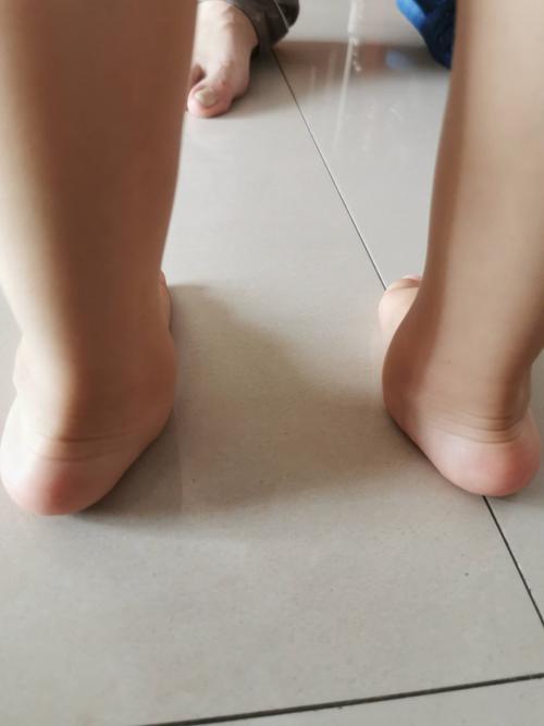 问:大夫您好,一岁8个月宝宝有足外翻,需要怎样治疗!