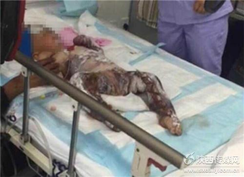 定边男童因车祸致全身大面积烧伤小孩生命垂危盼救助