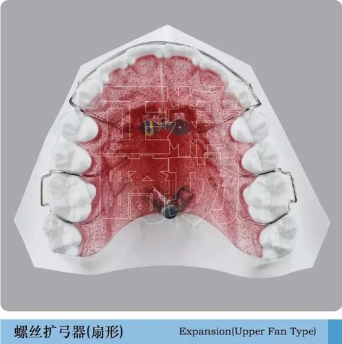 螺丝扩弓器(扇形)