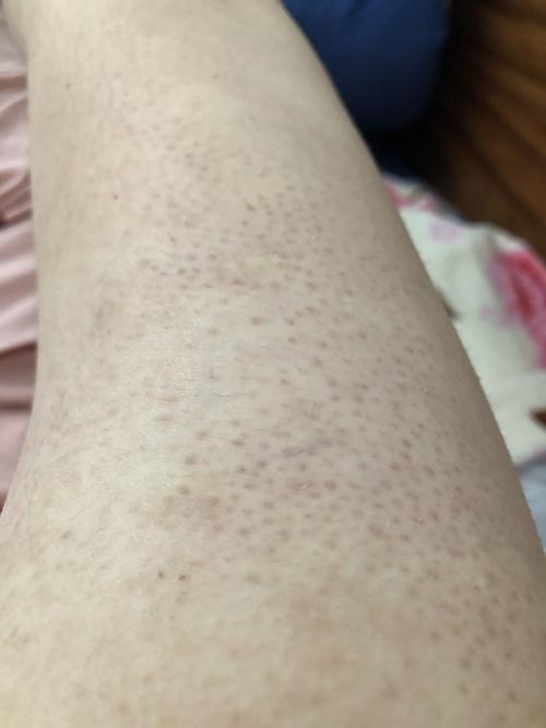 突然发现自己两个手臂成这样是毛囊炎吗