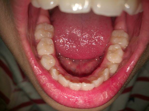 看牙不用再跑断腿,把牙齿照片发过来,方德君在线帮您解决问题!