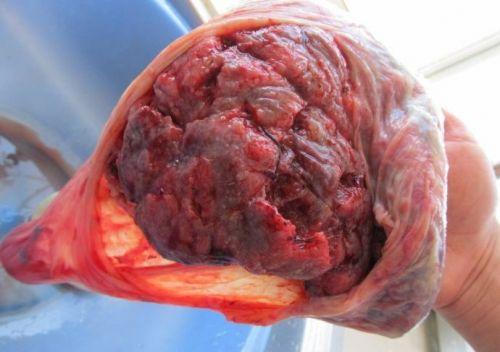 五胎妈妈为拼男孩,怀孕5个月胎死腹中,引产医生吓的直