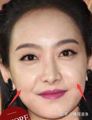 而苹果肌下垂会略显老