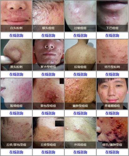 皮肤病的种类图片及治疗方法