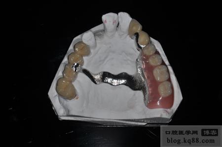 上颌口内观37拔除,34,35,36套筒冠设计如下:内冠口内粘结后支架就位