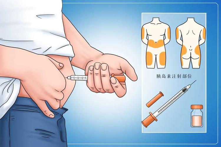 研究发现,腹部注射胰岛素疼痛程度较上臂外侧轻.