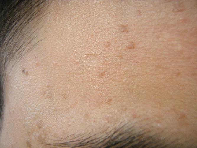 祛除扁平疣 工作好心情_皮肤科_阿里康网