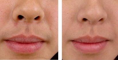 女神还是女汉子 冰点脱唇毛的费用高吗