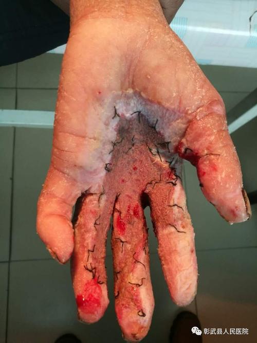 科室展示我的手能拿匙了双手电击伤vsd引流植皮复活记