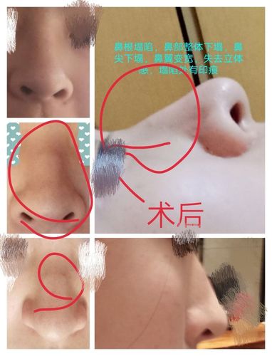 鼻中隔偏曲手术后鼻子塌了,如图,怎么办想找医院理赔