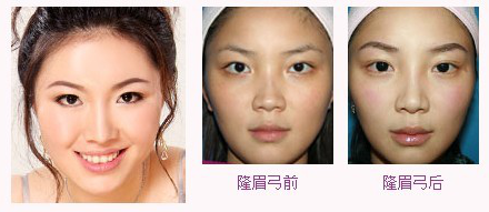 自体脂肪丰眉弓|北京伊美康医疗美容门诊部_悦美整形