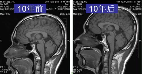 看完14 个病例,一起来认识这个表现多样的 rathke"s囊肿