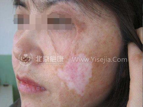 韩女士色素脱失,白斑疤痕治疗案例