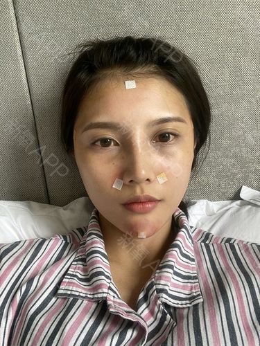 自体脂肪填充苹果肌