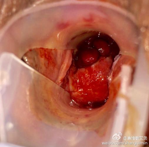 血性宫颈息肉火针治疗