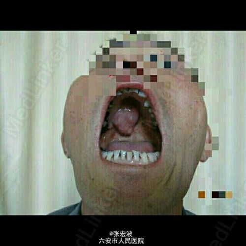 诊断 处理 诊断:右腭部肿瘤 治疗:全麻下行腭部肿瘤切除,术中冰冻