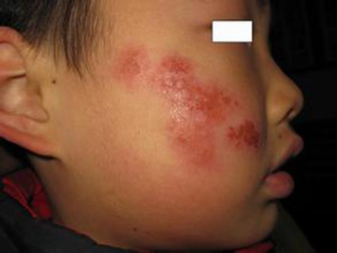 儿童单纯性疱疹溃疡图片