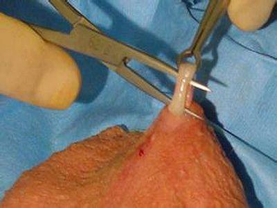 为了让老婆不受罪,他进行了结扎手术!