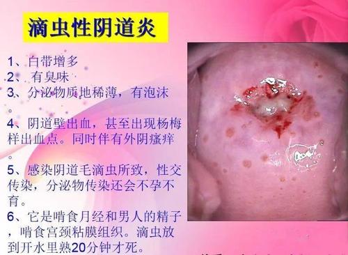 关注女性生殖健康——幸福健康带给你4