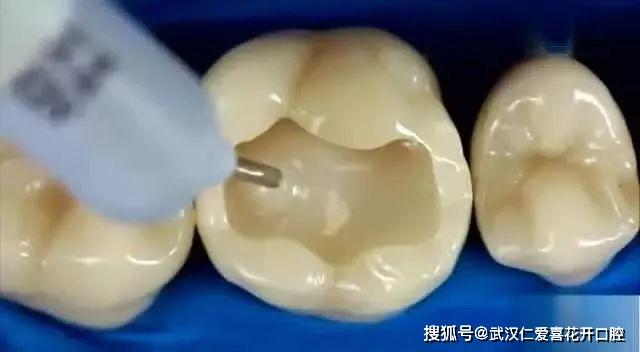 这得从牙齿结构说起了,这是一张健康牙齿的解剖示意图.