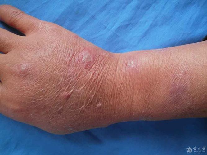 临床考虑白塞氏病一例.