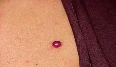 肝血管瘤能治吗