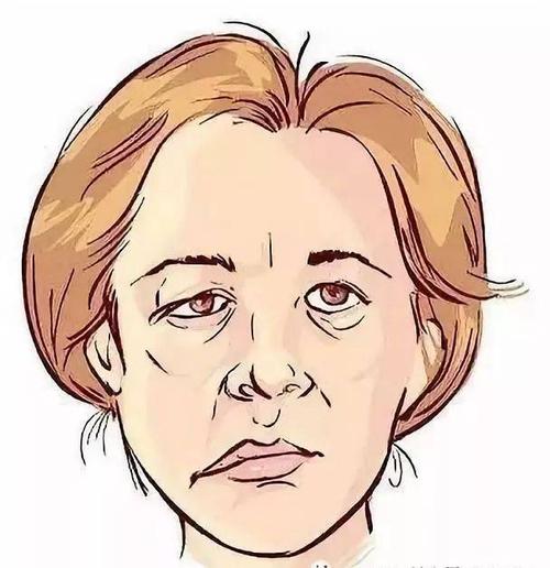 "1"看1张脸 不对称,口角歪斜.