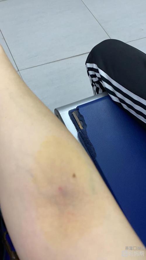 可怜啊,抽血抽的手都青了[泪]只愿指标能