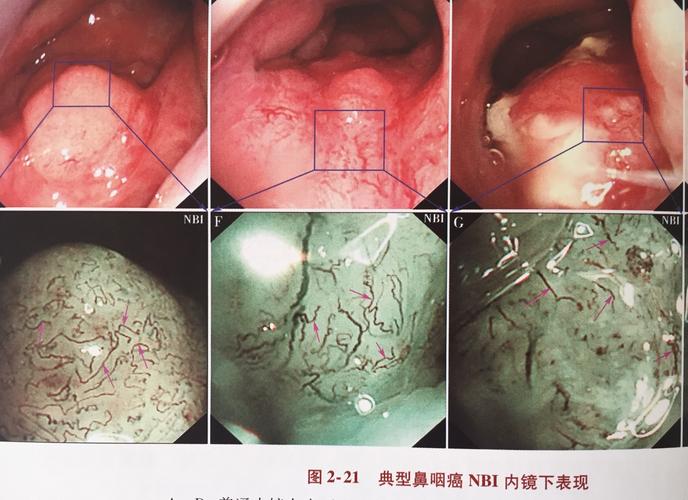 鼻咽癌早期改变.