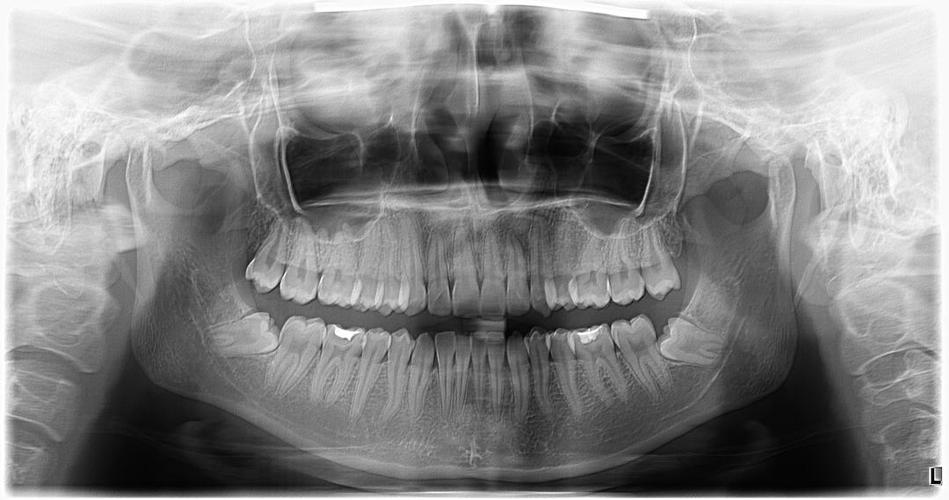 哭哭,我的智齿太靠近神经管了怎么办