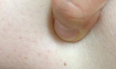 有哪些是乳癌征兆呢?