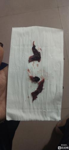 经历3次生化妊娠……注定无缘