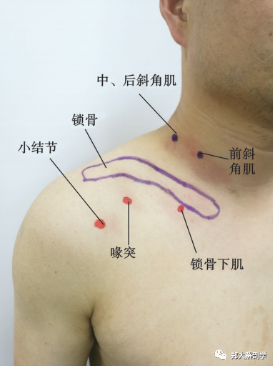 锁骨下肌治疗定点图 3.