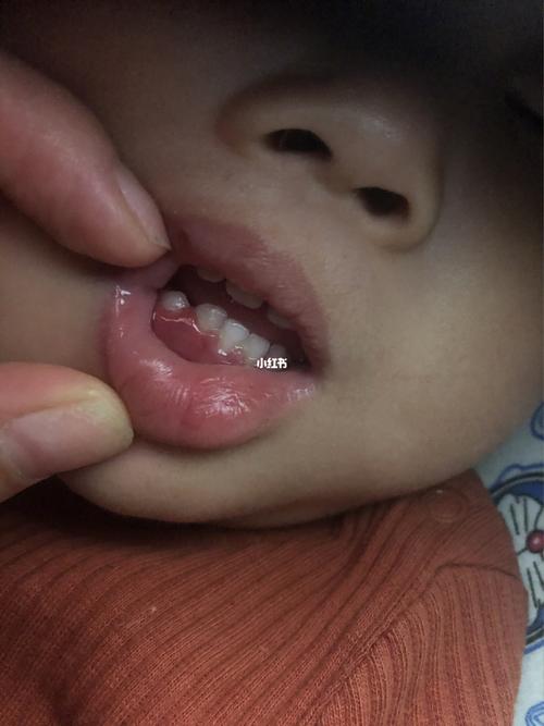 各位宝妈这是牙龈红肿吗_宝宝牙龈_母婴_育儿经验