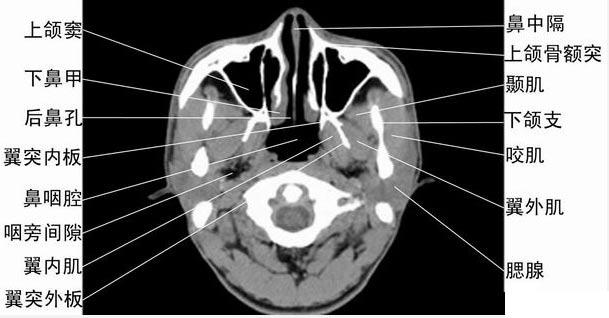 ct轴位鼻腔和鼻窦层面(图)