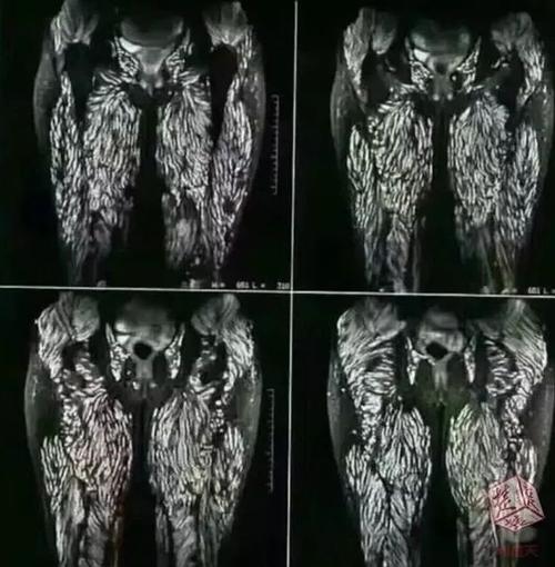邵阳一男子脑梗心梗并发,还感染 3 种寄生虫!医生:全是吃野味惹的祸