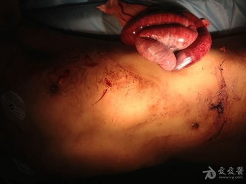 刺伤胸腹部4小时入院,入院一般情况可,无休克表现,胸部见多发刀刺伤口