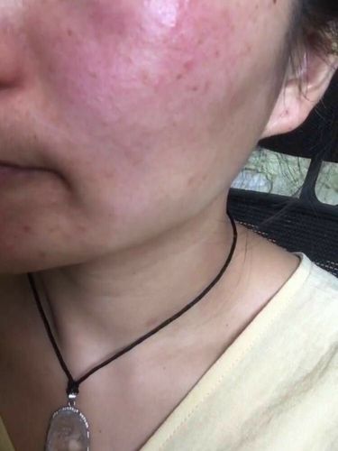 红血丝激素脸敏感肌发红发烫过敏皮炎_护肤品_皮炎_敏感肌_防晒_护肤