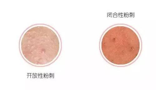 粉刺和闭口的区别是什么